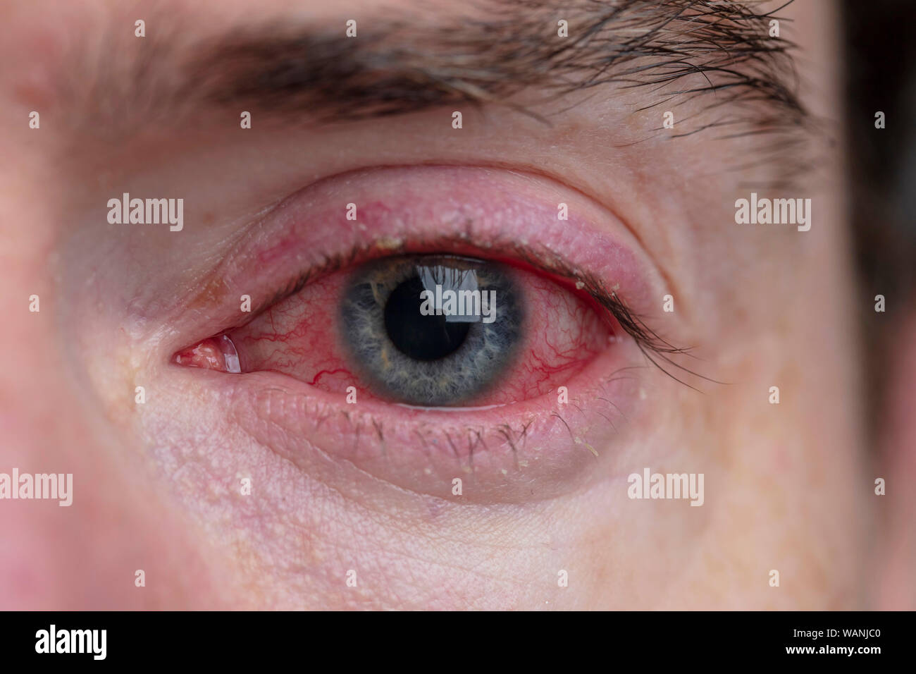 Close up d'un œil sévère rougeur. La blépharite, conjonctivite condition Banque D'Images