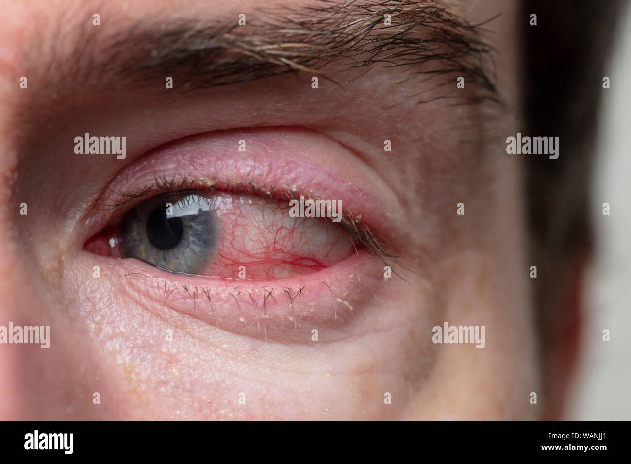 Close up d'un œil sévère rougeur. La blépharite, conjonctivite condition Banque D'Images