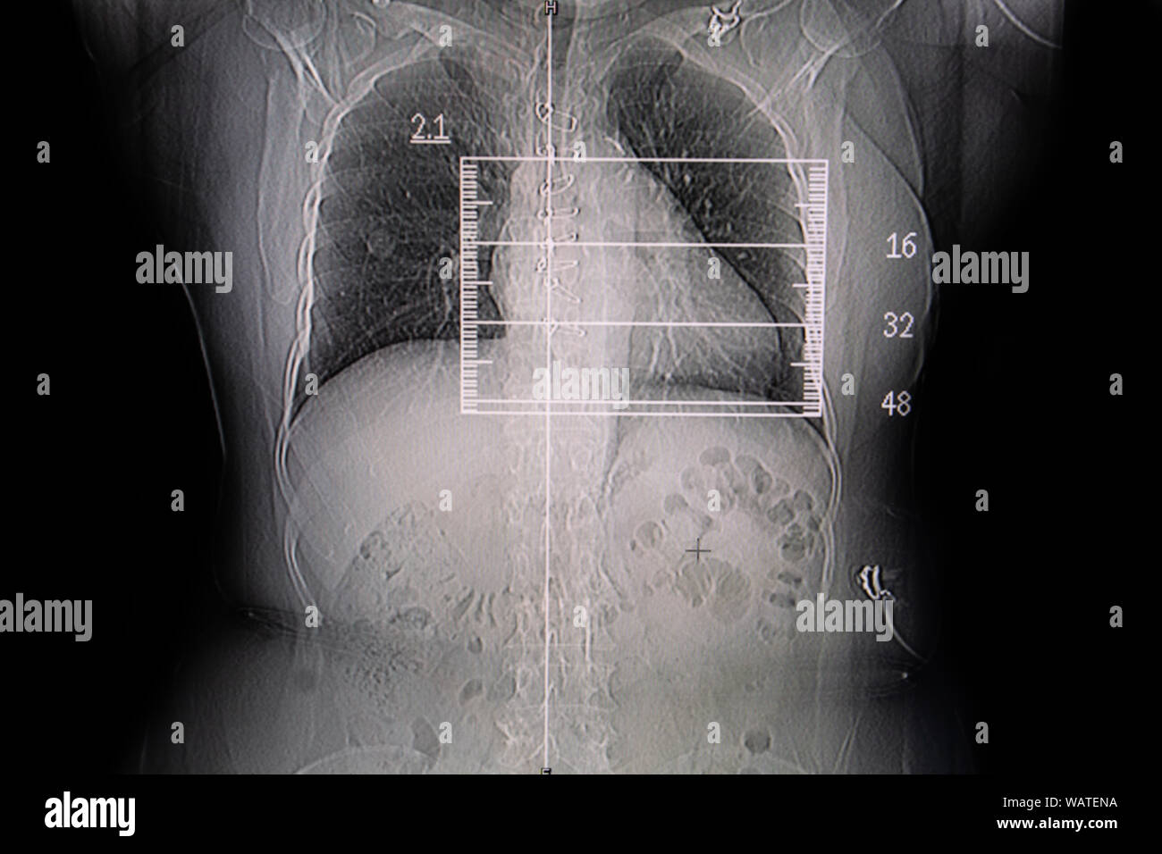 Définir la radiographie film pris d'examiner le coeur. Concept de la santé. Banque D'Images