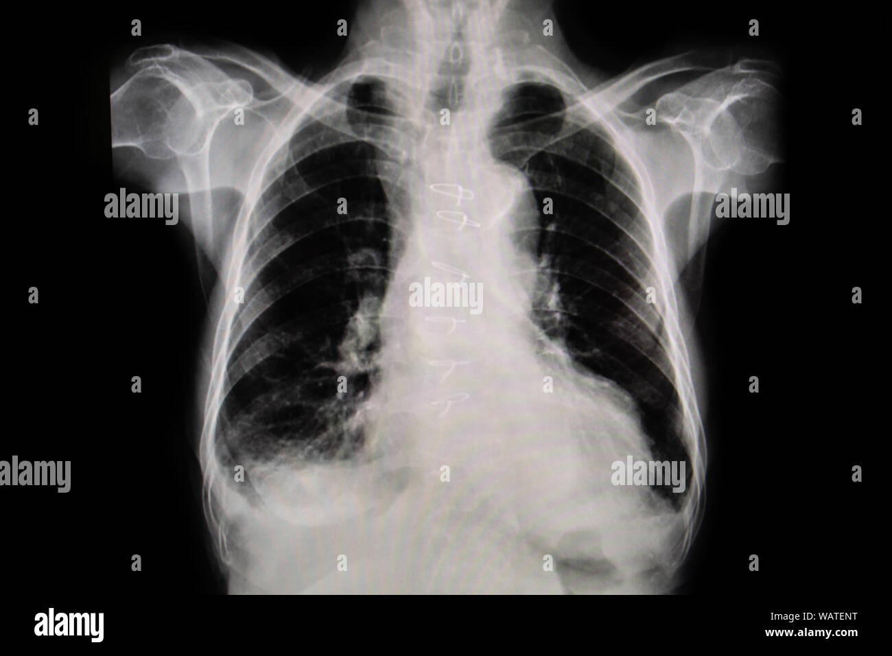 Définir la radiographie film pris d'examiner le coeur. Concept de la santé. Banque D'Images