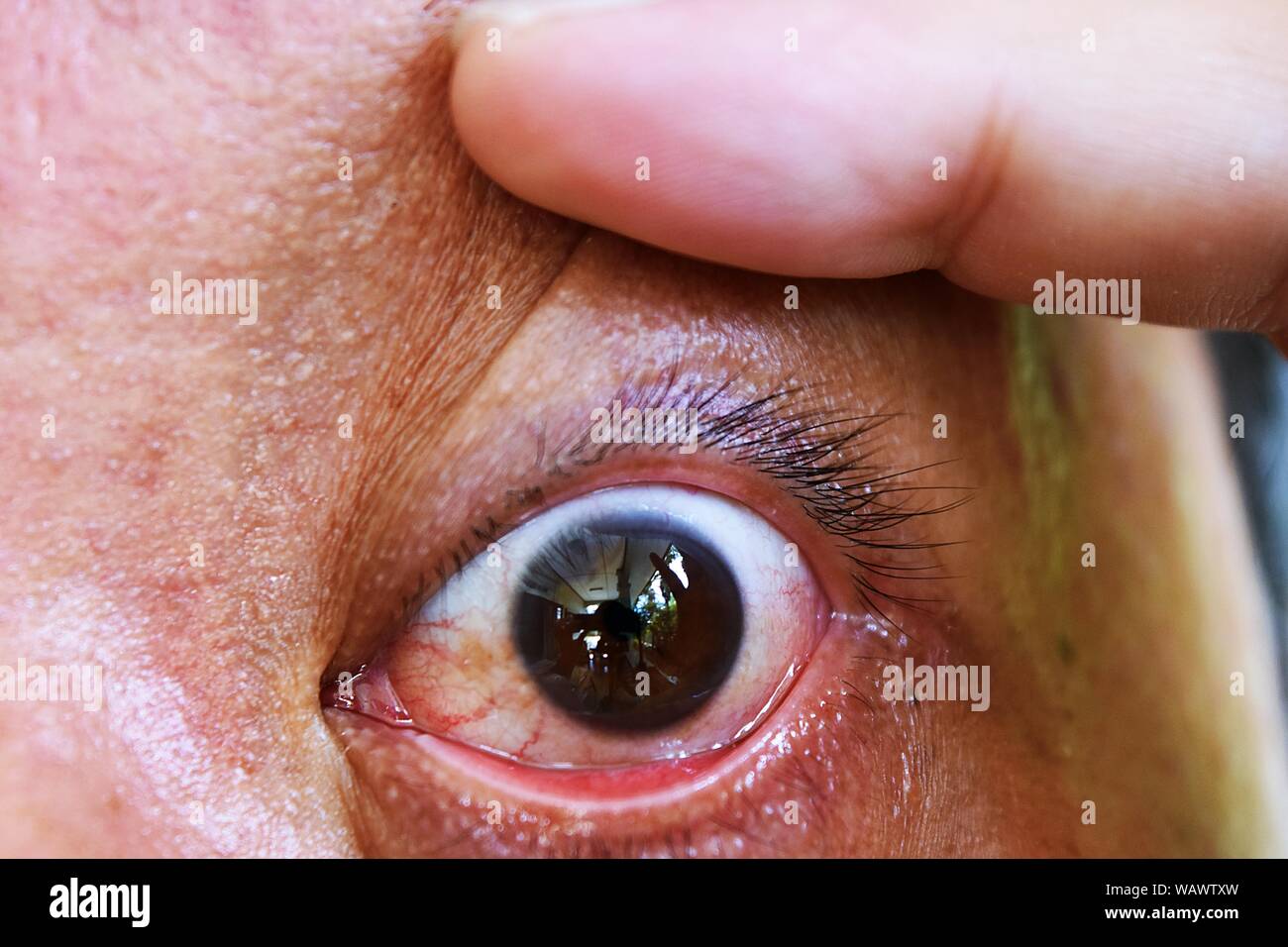 Ouvrez les doigts les yeux ouverts et révèle de nombreux capillaires rouges sur le globe oculaire qui peut être malade , Close - up Scary eye of Asian men Banque D'Images