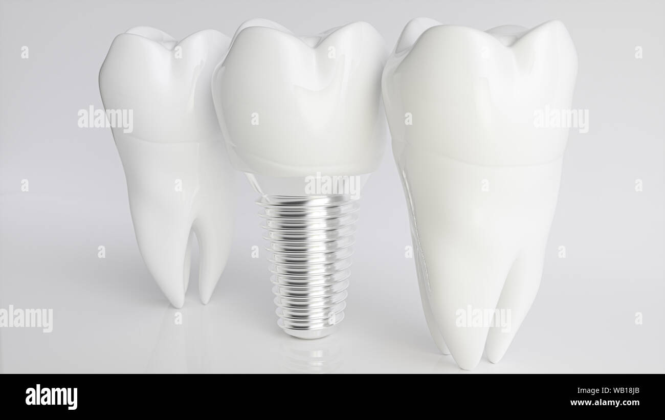 Un implant comparé à des dents saines - rendu 3d Banque D'Images