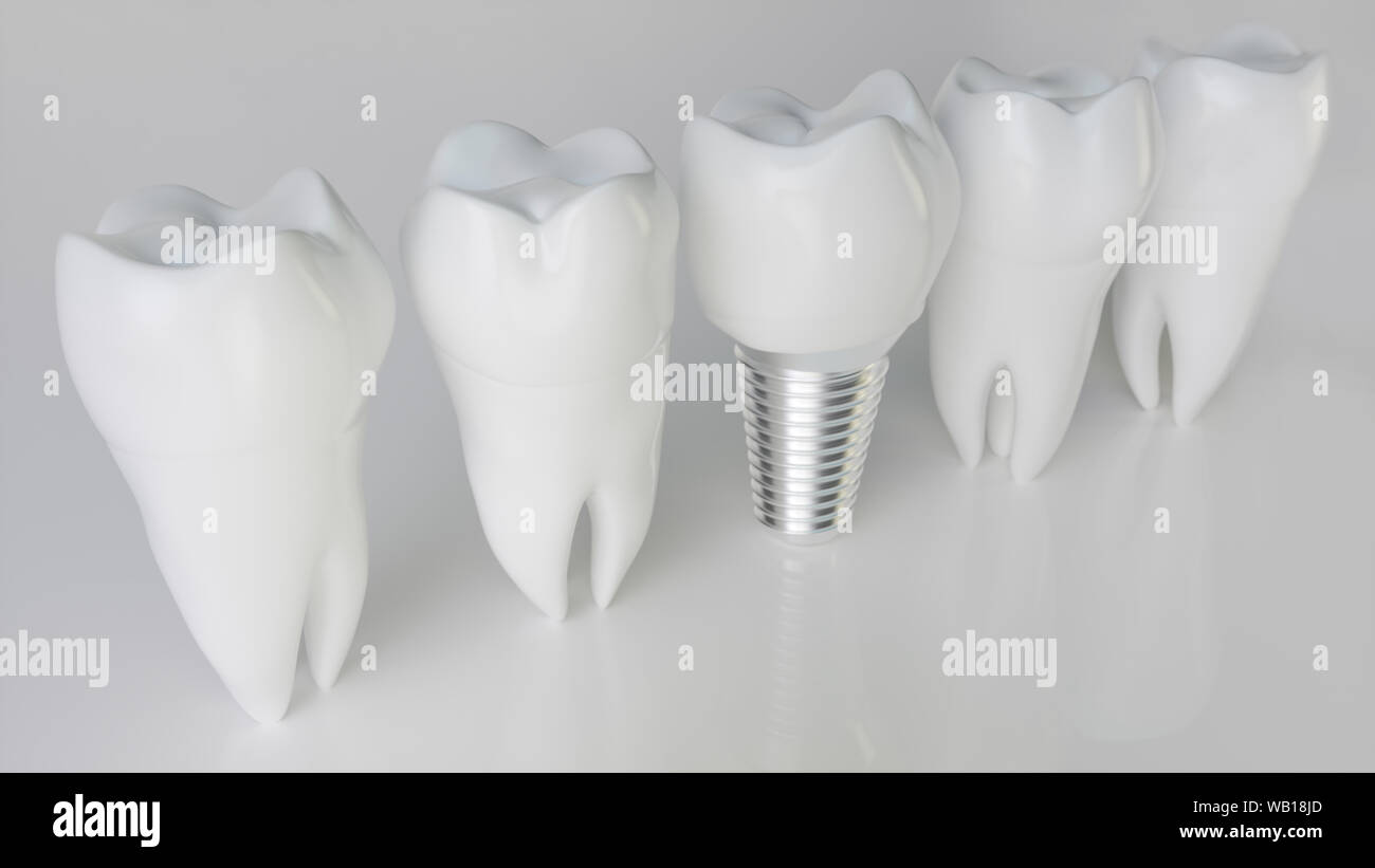 Un implant comparé à des dents saines - rendu 3d Banque D'Images