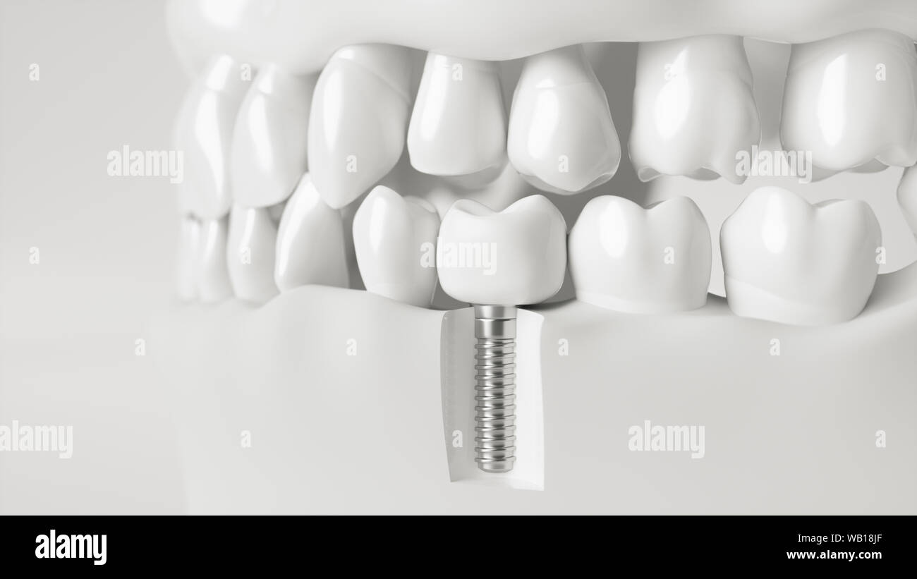 Un implant dans la mâchoire - rendu 3d Banque D'Images