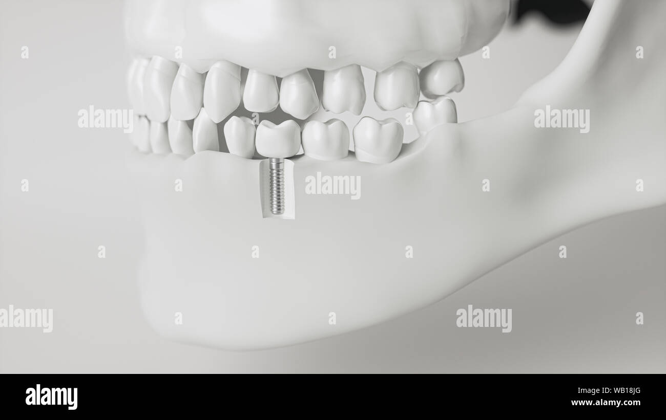 Un implant dans la mâchoire - rendu 3d Banque D'Images