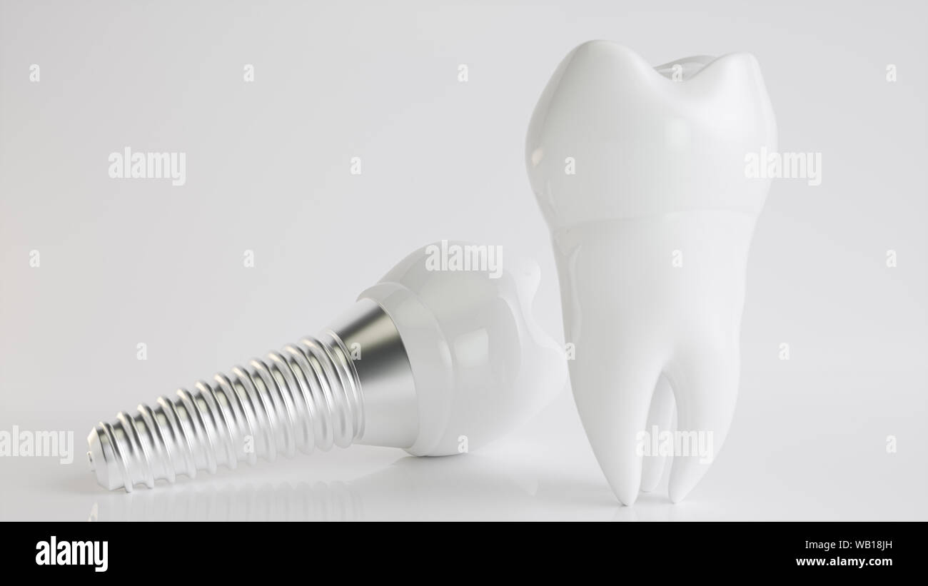 Un implant comparé à des dents saines - rendu 3d Banque D'Images