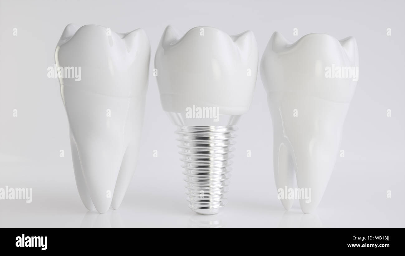 Un implant comparé à des dents saines - rendu 3d Banque D'Images