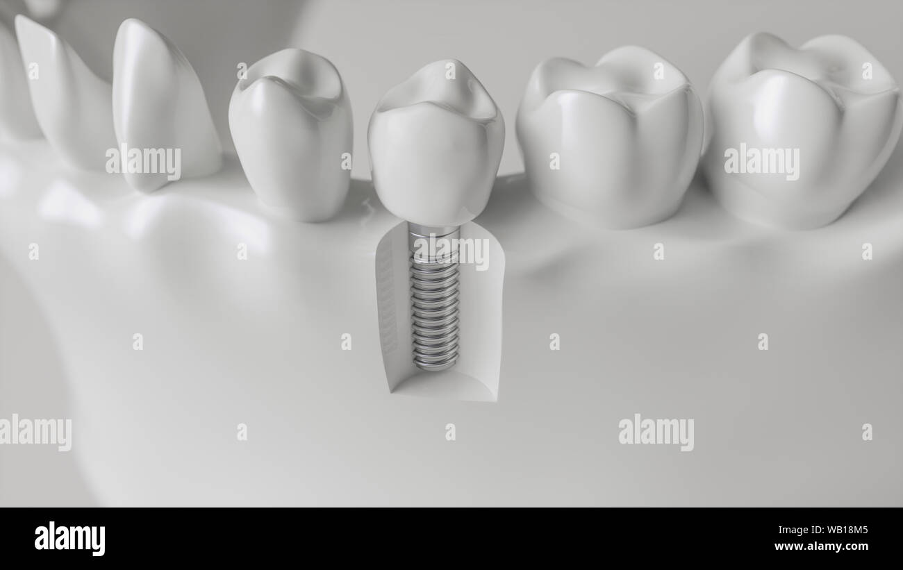 Un implant dans la mâchoire - rendu 3d Banque D'Images