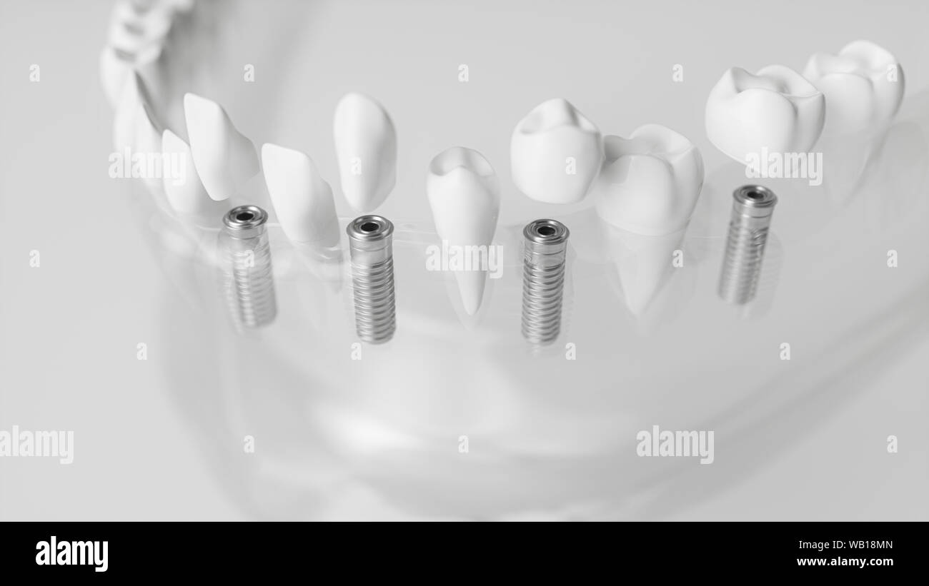 Plusieurs implants dans une mâchoire vitrieuse - rendu 3d Banque D'Images