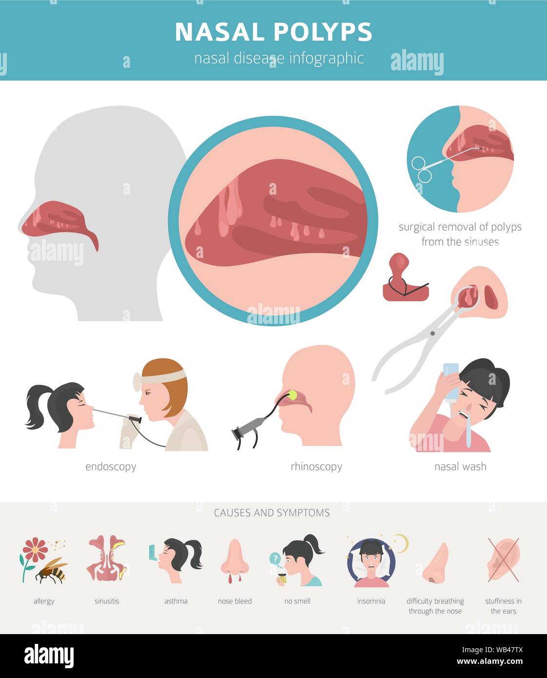 Polype Nasal Banque D Image Et Photos Alamy