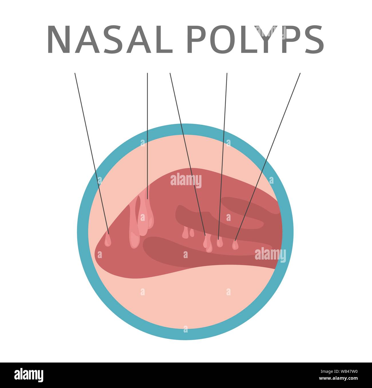 Maladies du nez. Polypes nasaux les causes, le diagnostic et le traitement de la conception infographique médical. Vector illustration Illustration de Vecteur