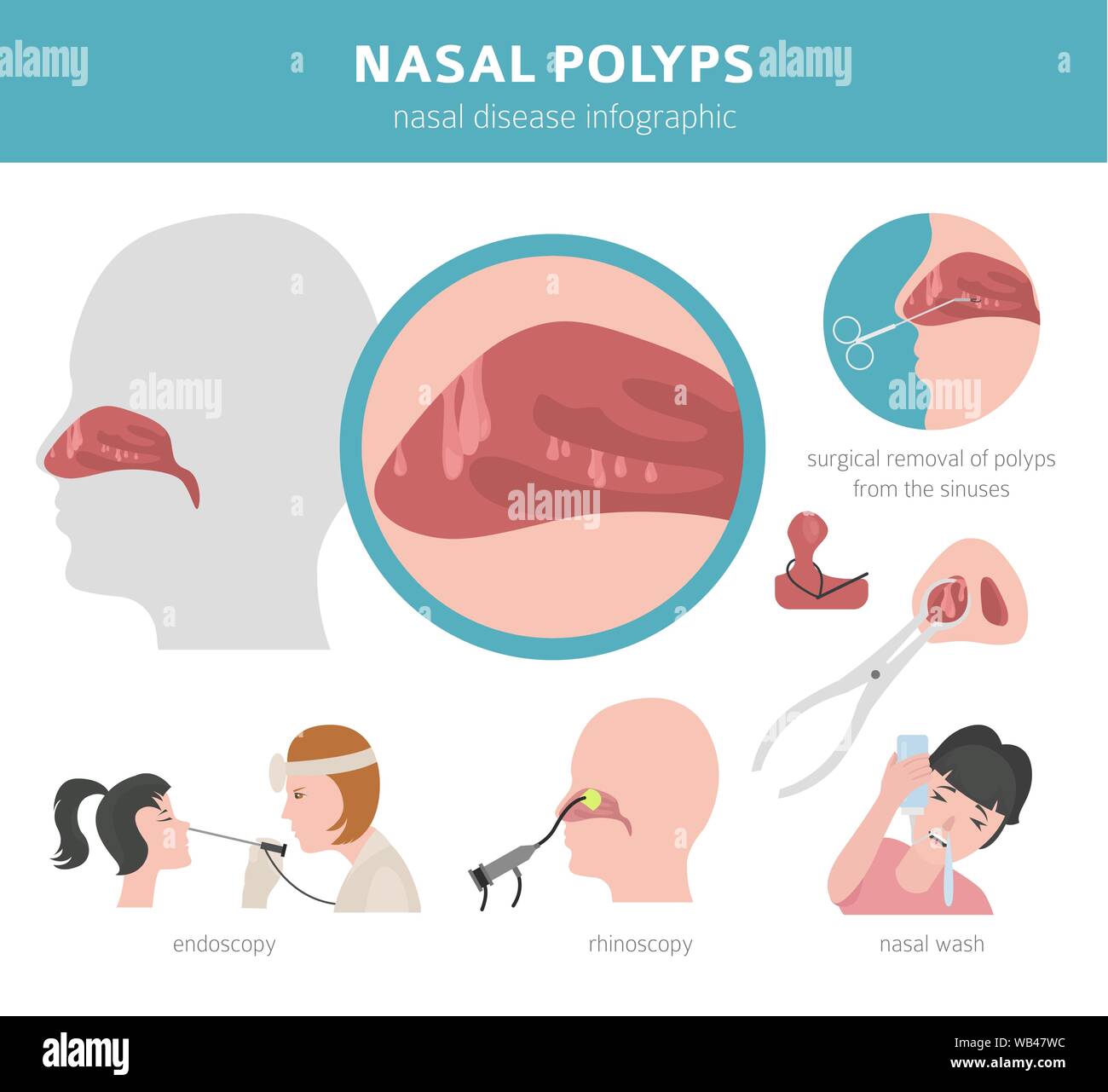 Polype Nasal Banque D Image Et Photos Alamy
