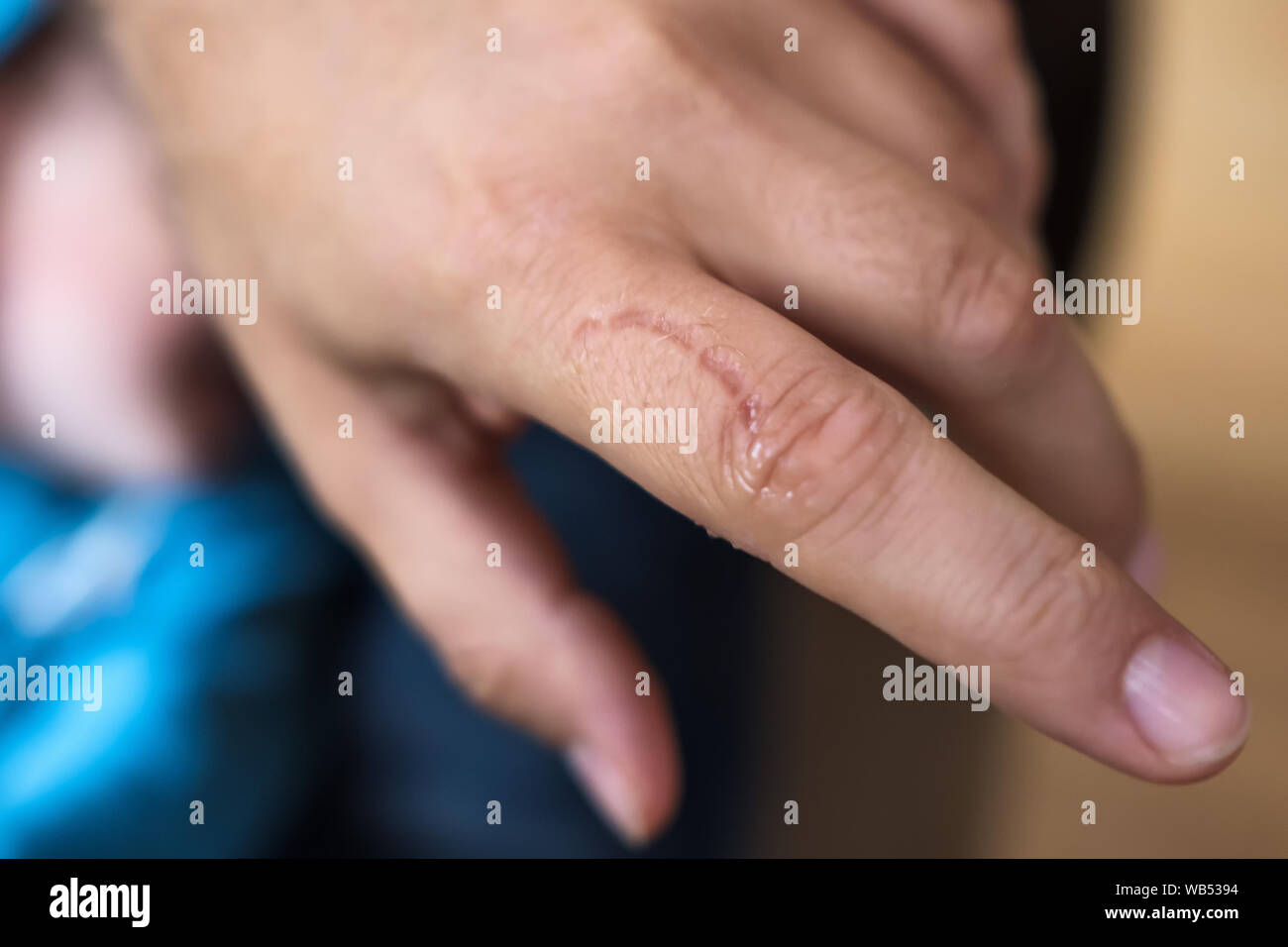 Trace de morsure de dents sur la peau. Mauvais comportement de concept de l'enfant Banque D'Images