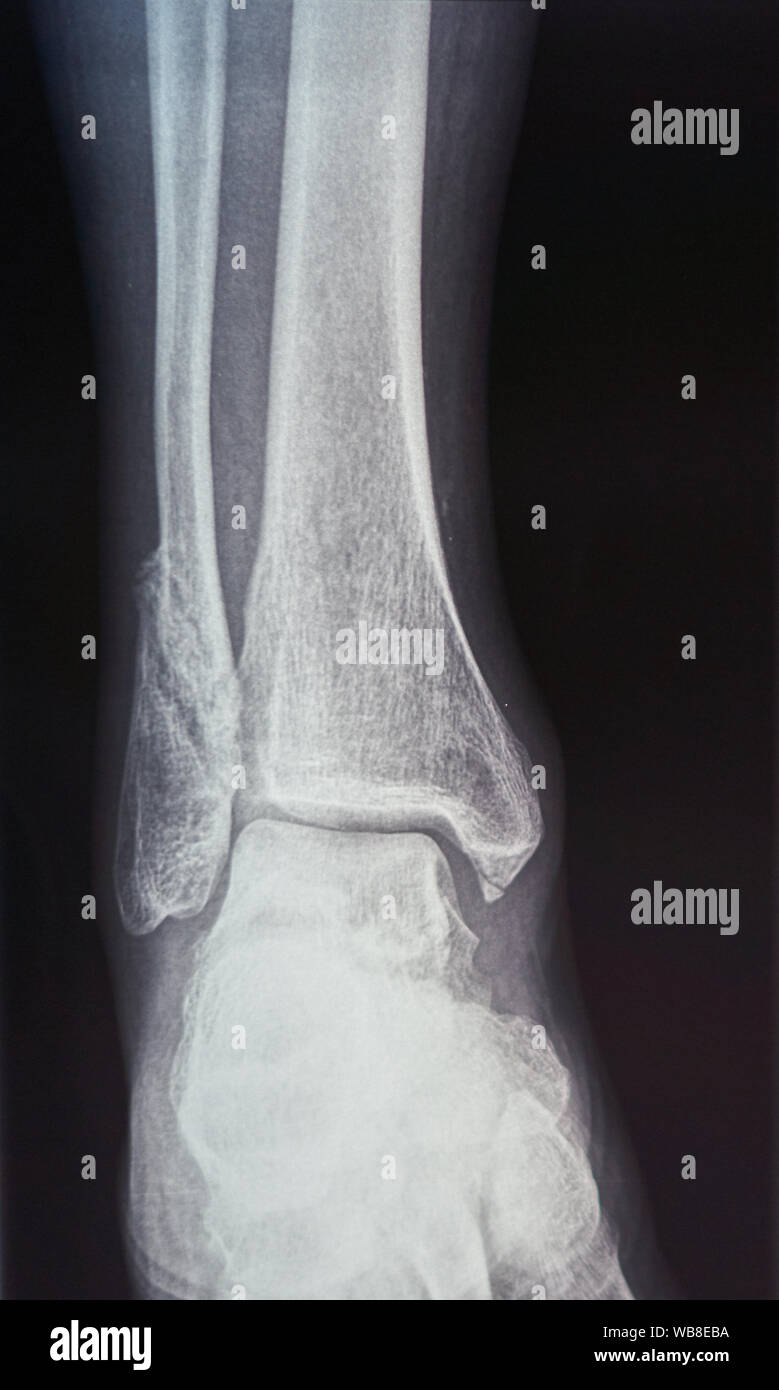 Scan des os d'un pied Banque D'Images