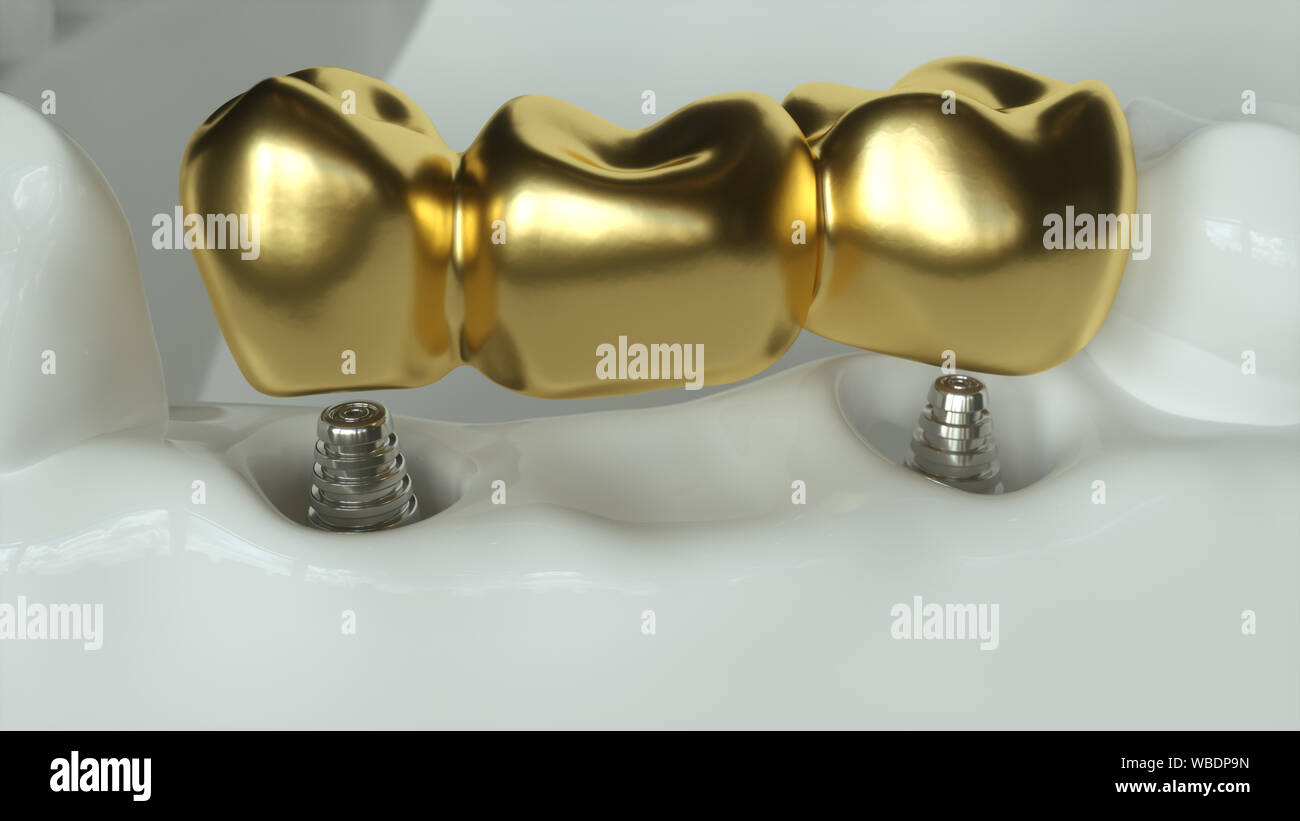 Les implants avec un golden bridge dentaire - 3D Rendering Banque D'Images