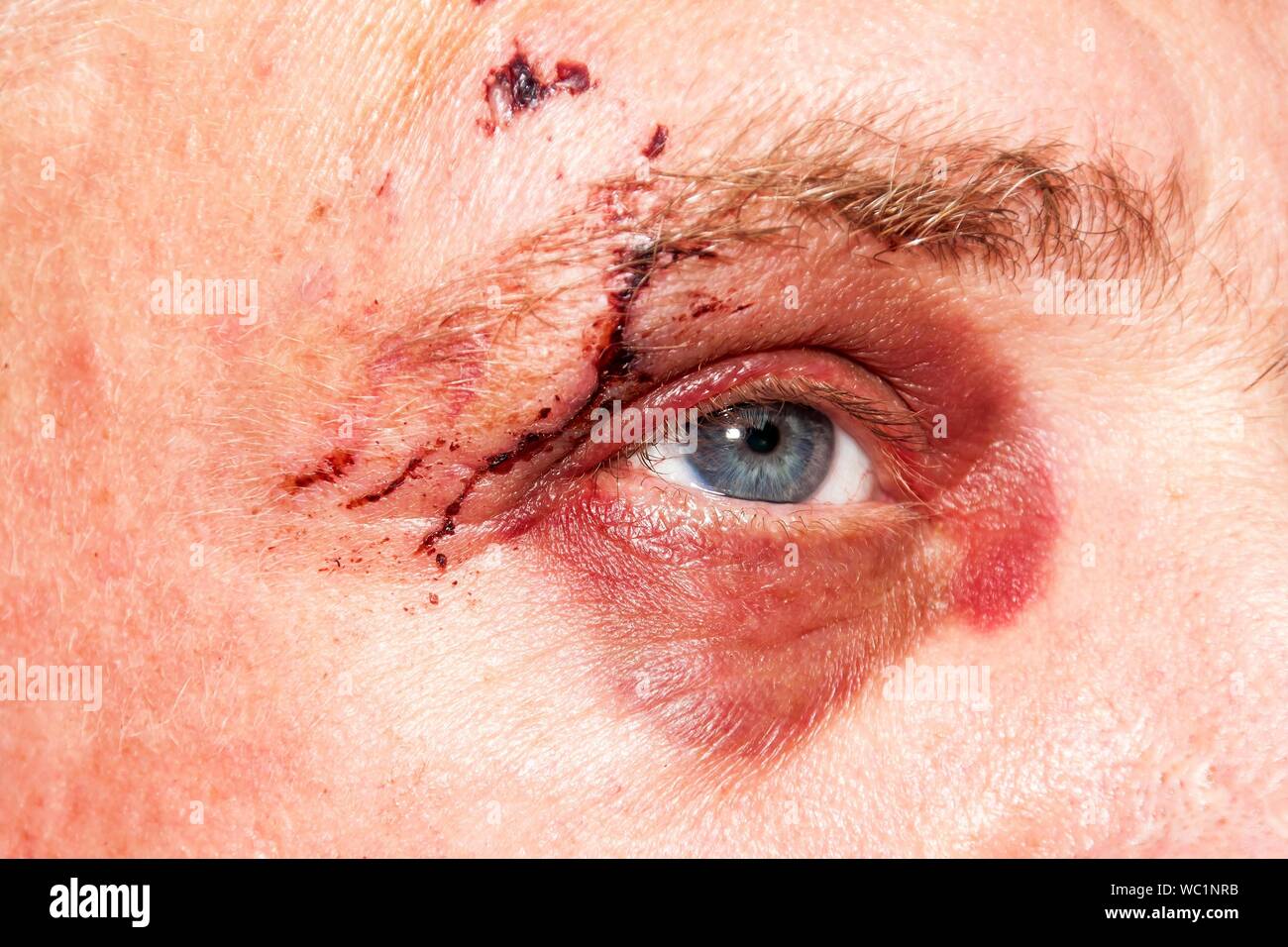 Homme avec un grand œil bleu violet. Chien mordant sur le visage. Blessure à l'œil. Gros hématomes sur l'œil masculin. Le traitement de blessures. Oeil Boxer. Banque D'Images
