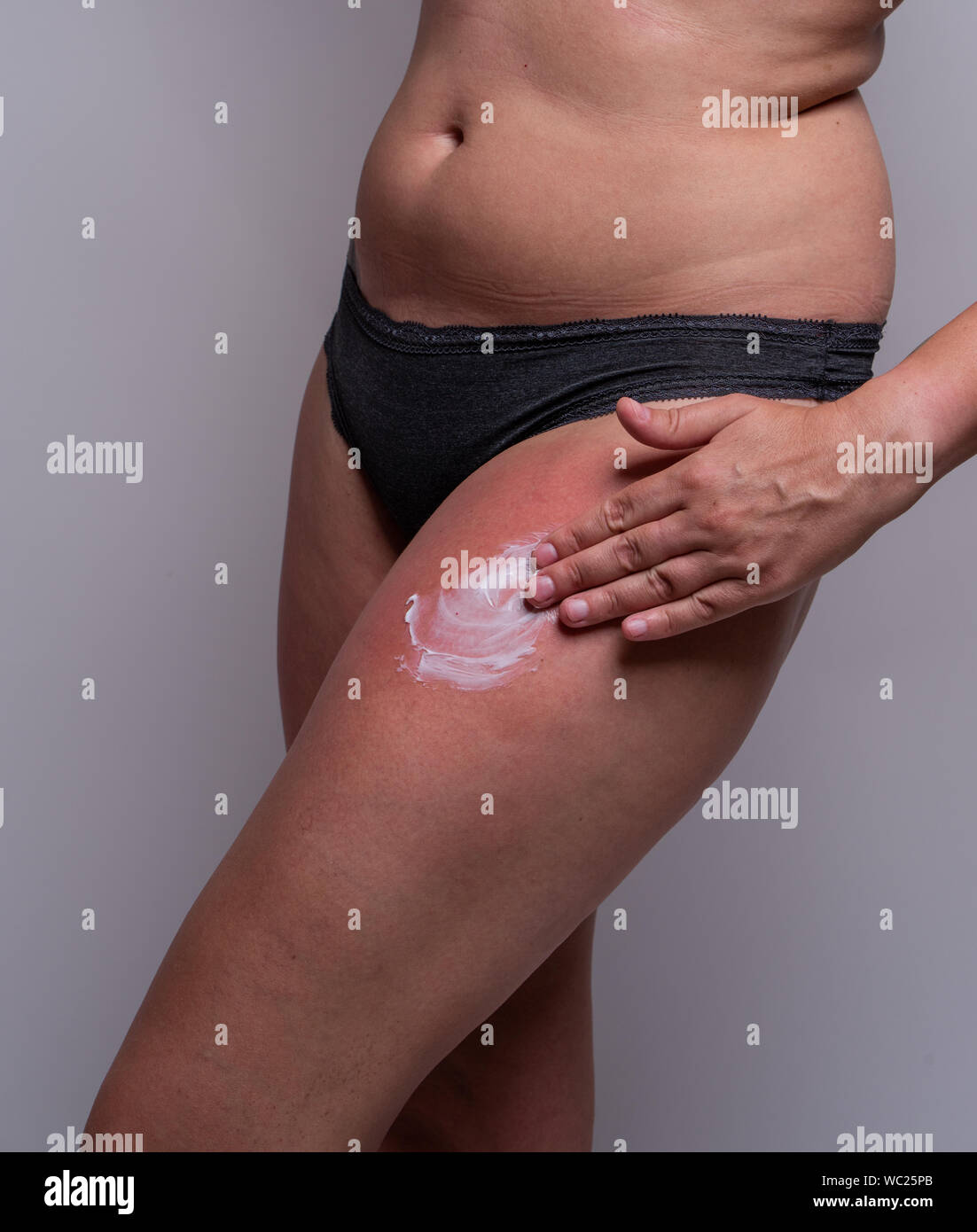 Close up of woman avec le coup de soleil sur les jambes à l'aide de la crème. Affichage d'une jambe avec la main Banque D'Images