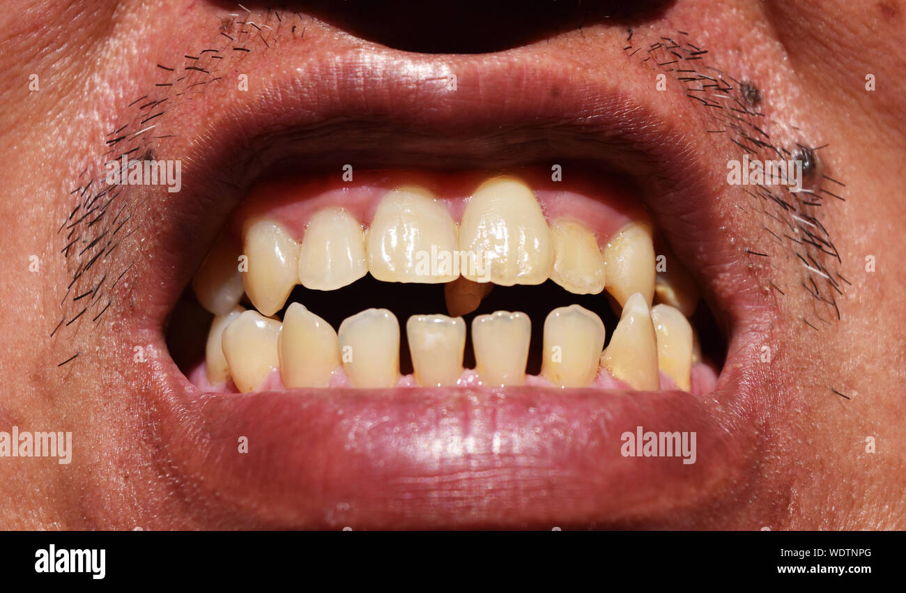 Close - up la rangée de dents avec tache jaune et la distance, les gencives rouges dans la bouche des hommes, et de la santé bucco-dentaire doit être maintenue et traités Banque D'Images
