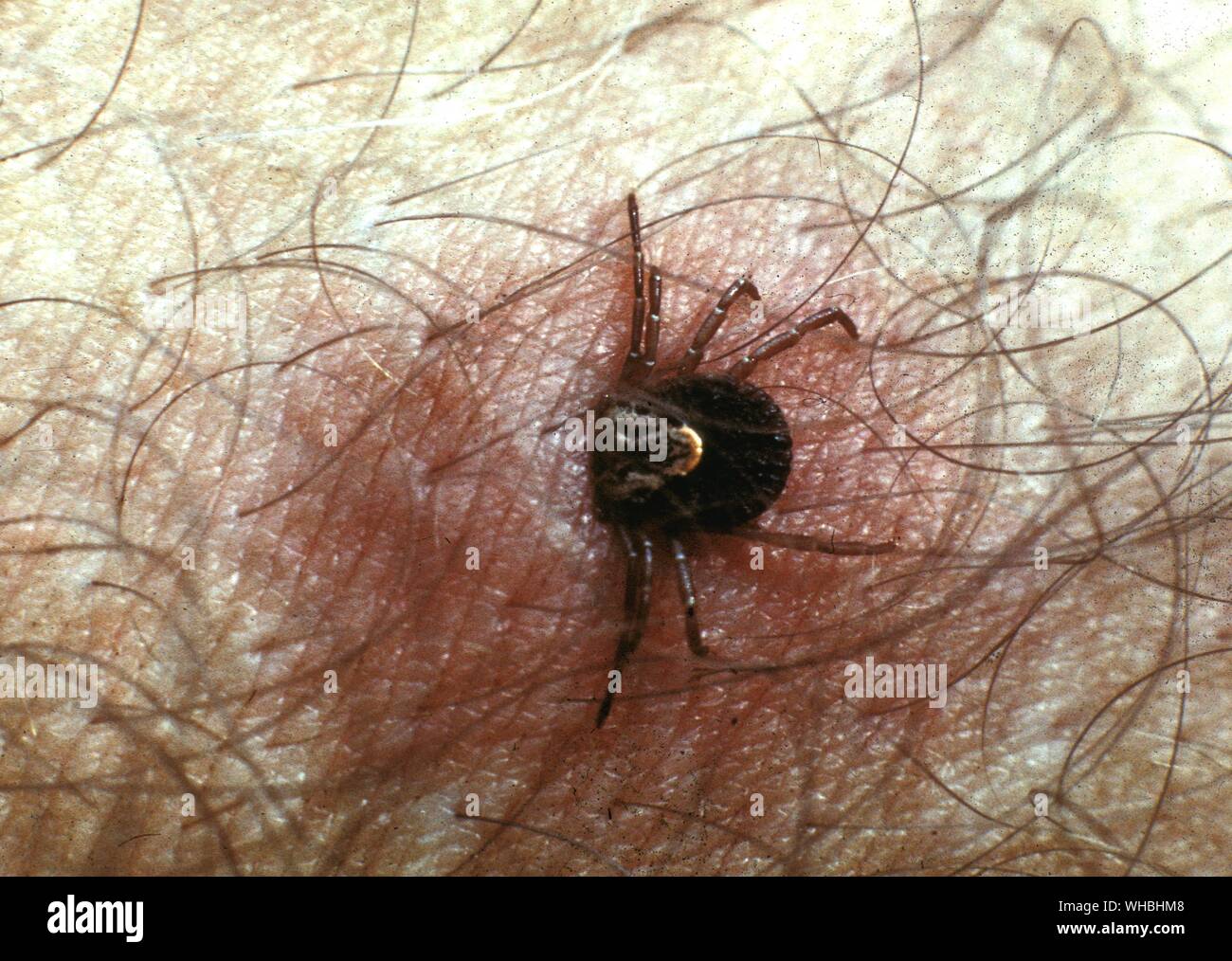 Vue microscopique d'un trait à un bras humain , Brésil Banque D'Images