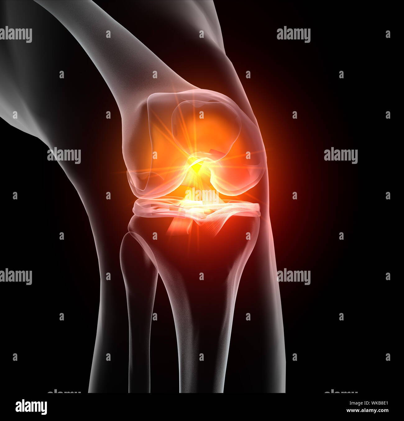 Médicalement précis 3D illustration montrant l'articulation du genou douloureux avec mis en évidence du ligament croisé antérieur et postérieur, ménisque, cartilage articulaire Banque D'Images