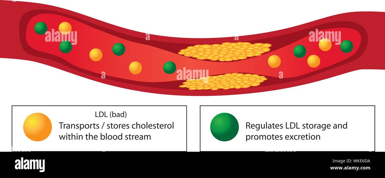 Plaque athérosclérotique de vaisseau sanguin et de bons et mauvais lipides vector infographie Illustration de Vecteur