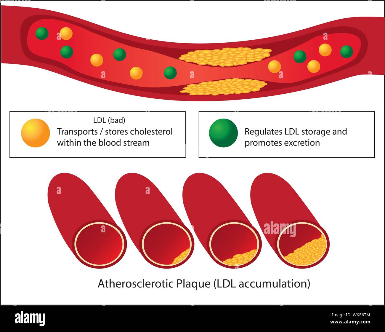 Rôle des bons et mauvais lipides et niveaux de plaque athérosclérotique de vaisseau sanguin vecteur médicale infographie Illustration de Vecteur
