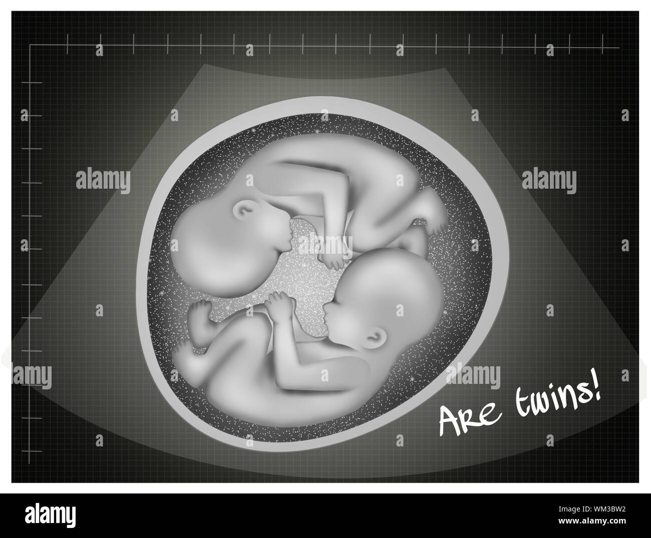 L'échographie de jumeaux Photo Stock Alamy — free download