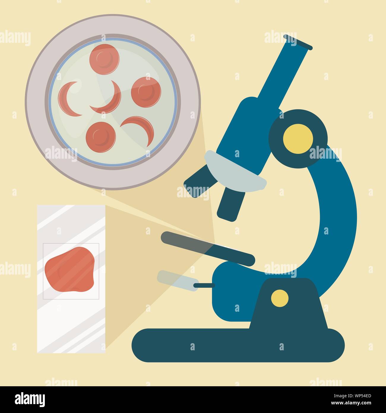 Échantillon de sang au microscope montrant les globules rouges de drépanocytose globules rouges. Microscope avec échantillon de sang. Illustration de Vecteur