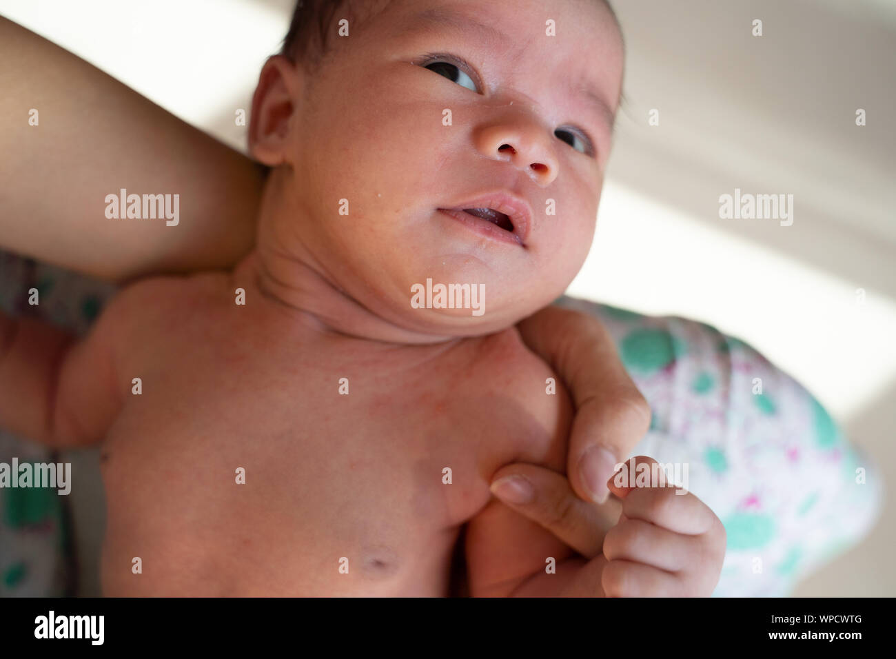 Allergic Reaction Child Banque De Photographies Et D Images A Haute Resolution Alamy
