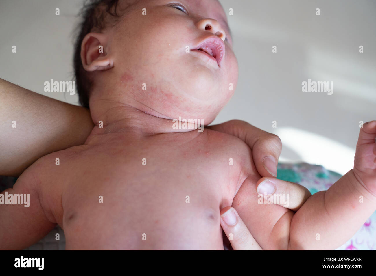 Jeune Bebe Avec Irritation De La Peau Ou De L Eczema Sur Le Ventre Photo Stock Alamy
