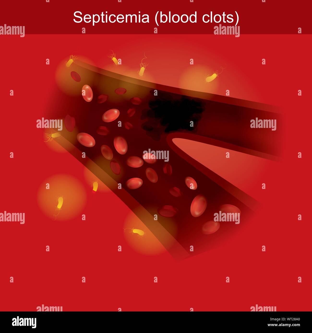 L'inflammation causée par des infections bactériennes dans le sang provoque des voies de la coagulation dans les vaisseaux sanguins pour causer l'incapacité d'oxygène transport Illustration de Vecteur