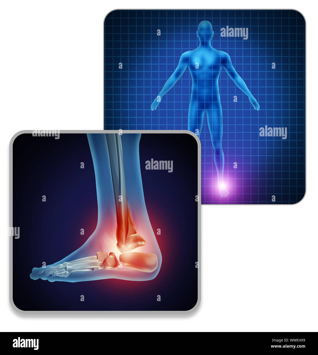 Pied humain la douleur commune concept comme squelette et muscle anatomie du pied avec un groupe de douleurs articulaires comme une douloureuse blessure ou maladie de l'arthrite. Banque D'Images Pied humain la douleur commune concept comme squelette et muscle anatomie du pied avec un groupe de douleurs articulaires comme une douloureuse blessure ou maladie de l'arthrite. Banque D'Images