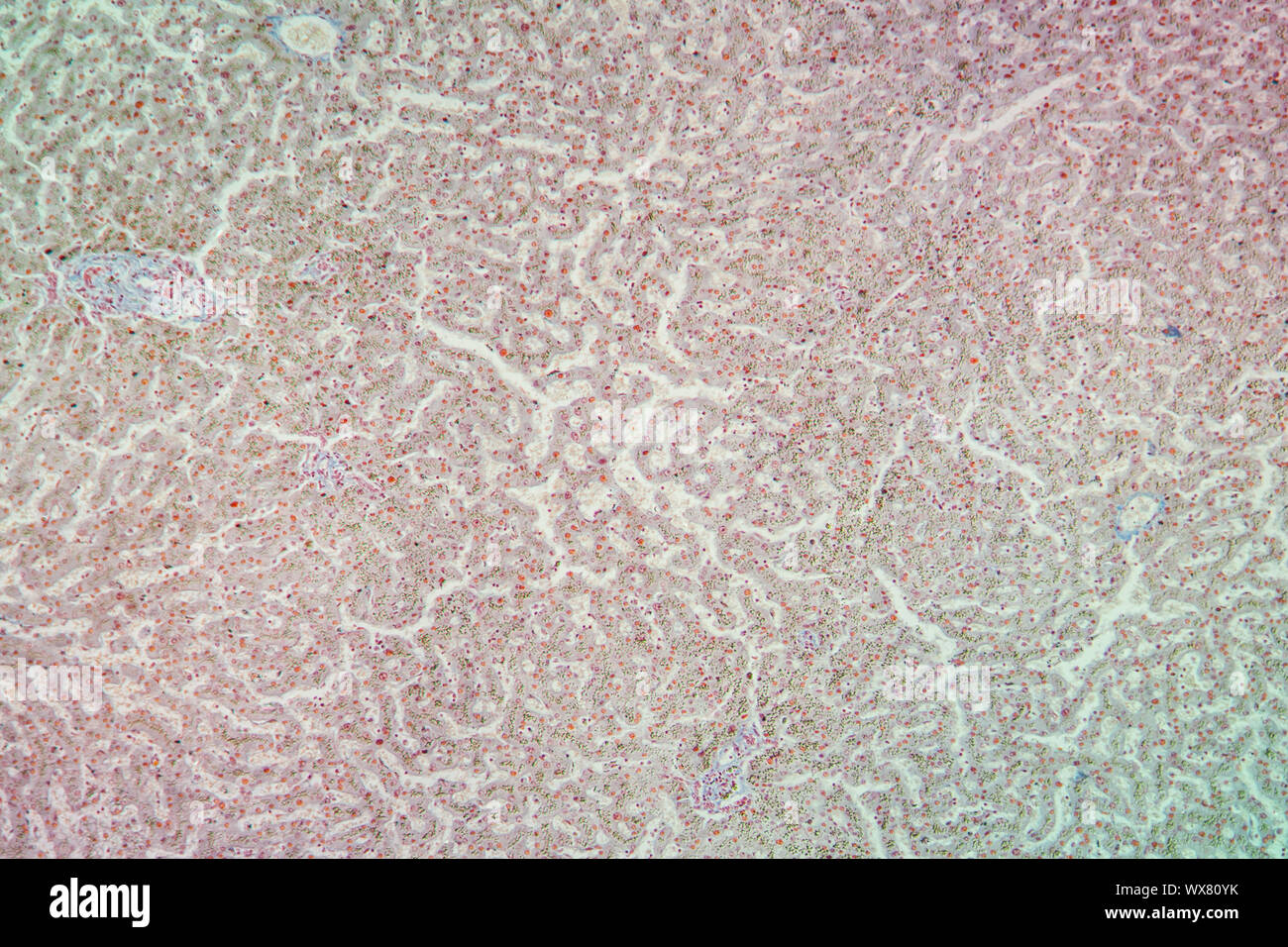 Hémosidérose des tissus hépatiques sous le microscope 100x Banque D'Images
