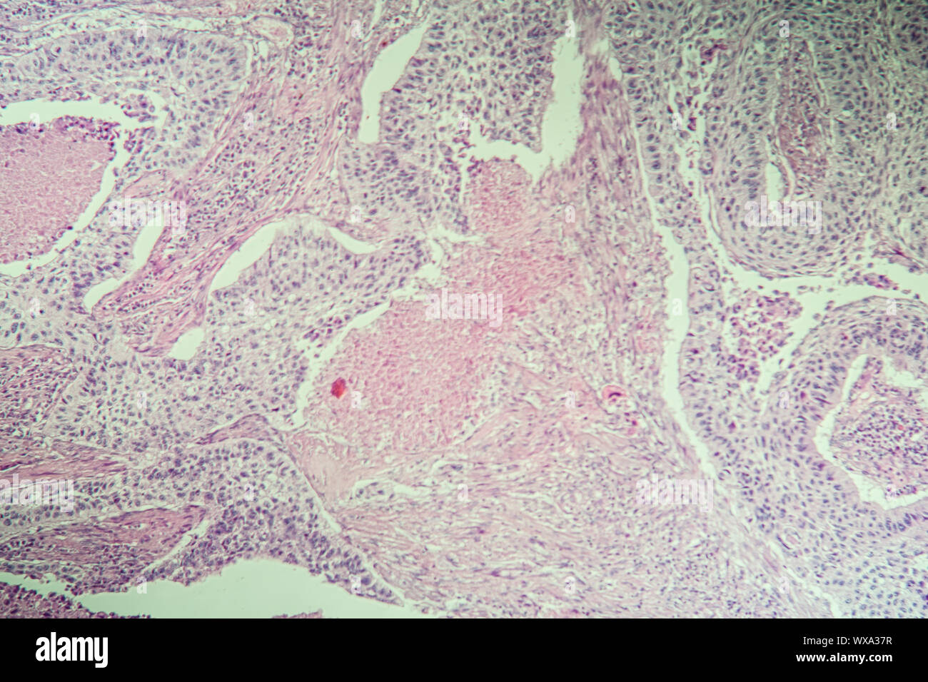 Carcinome cellulaire des tissus malades sous le microscope 100x Banque D'Images