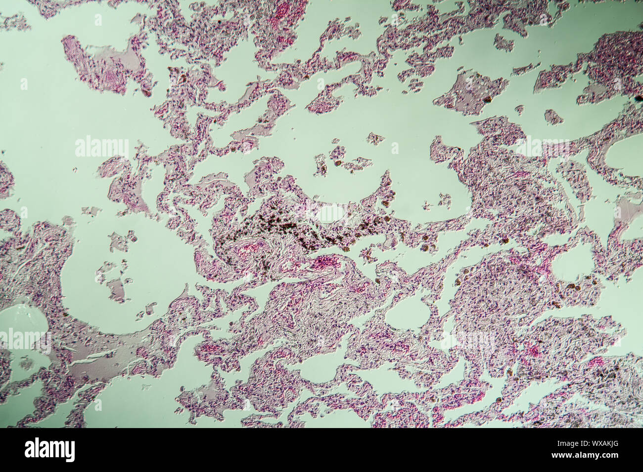 La silicose pulmonaire de tissu pulmonaire 100x Banque D'Images