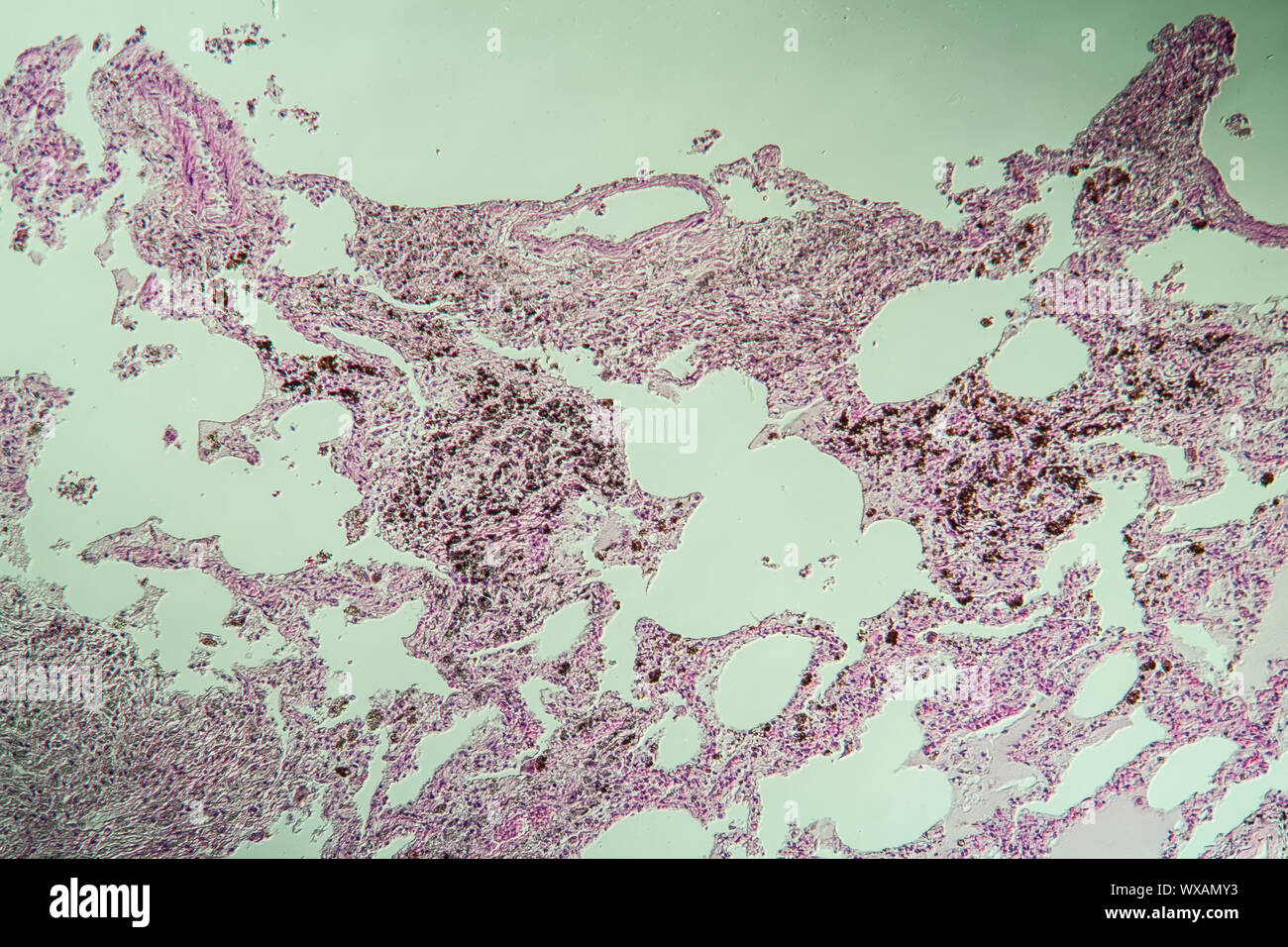 La silicose pulmonaire de tissu pulmonaire sous le microscope 100x Banque D'Images