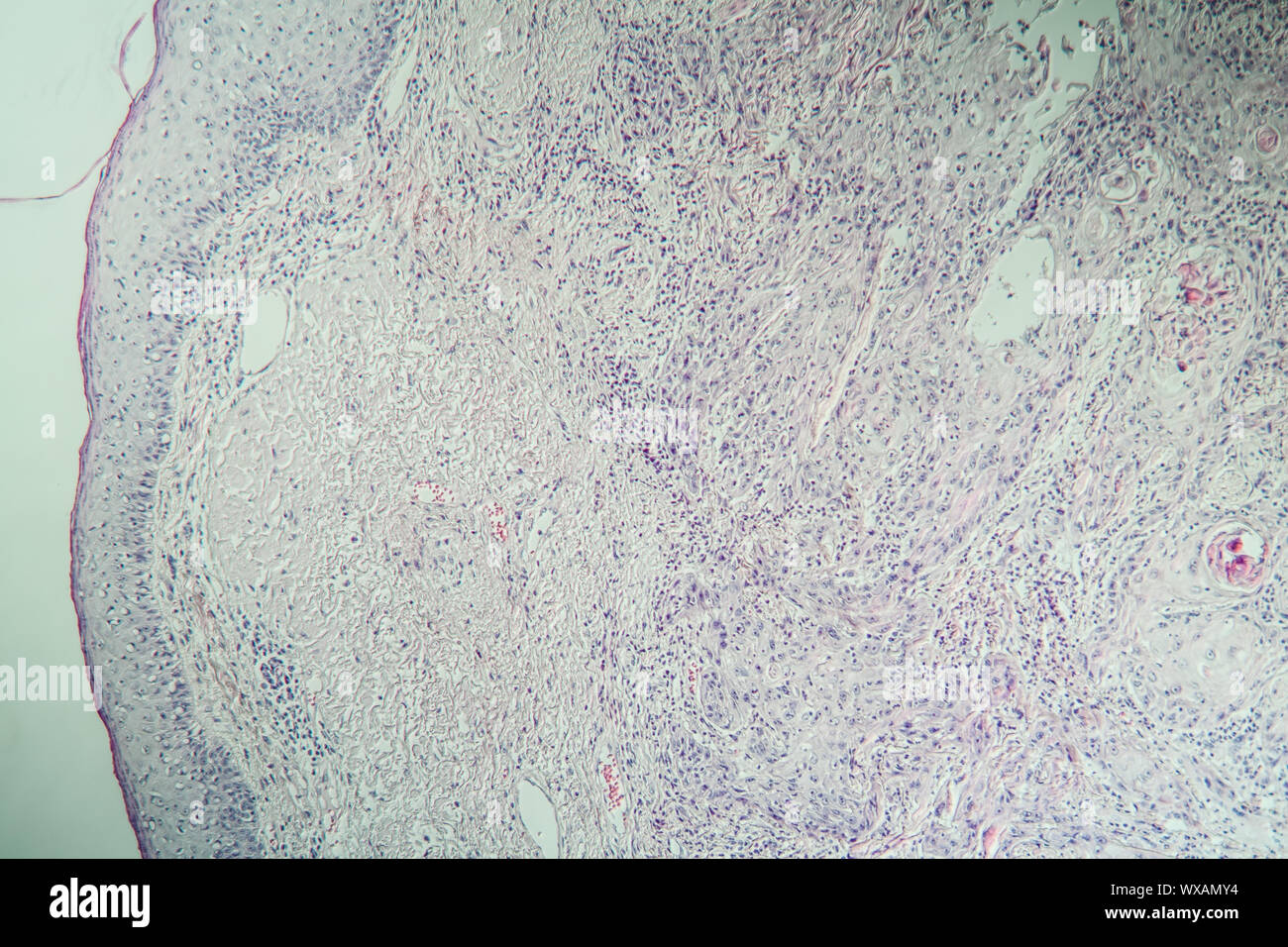 Carcinome lèvres sous le microscope 100x Banque D'Images