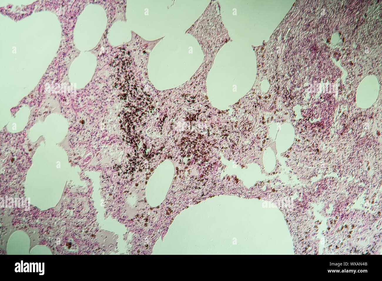 La silicose pulmonaire de tissu pulmonaire 100x Banque D'Images