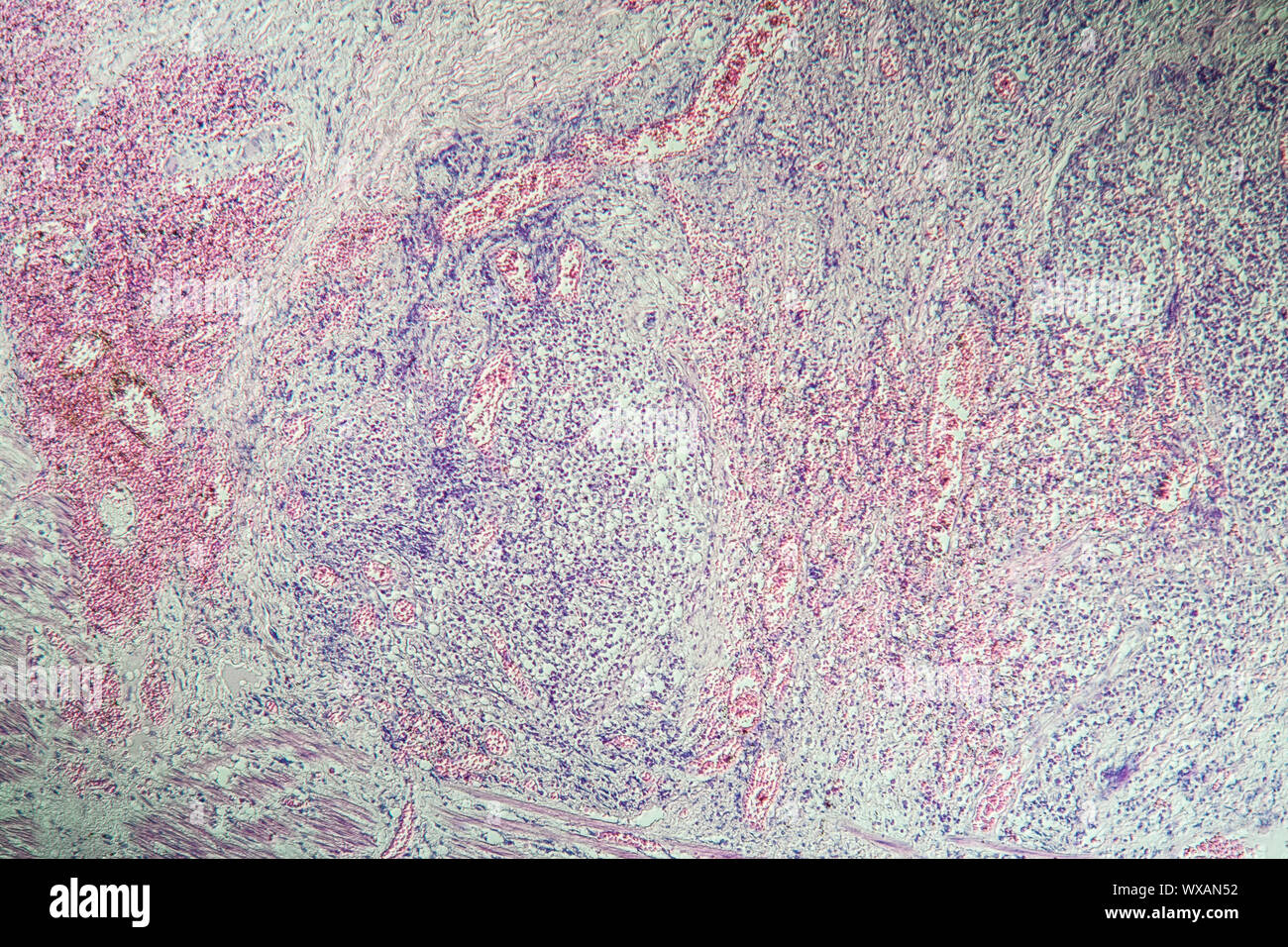 La maladie de Crohn, l'inflammation intestinale sous le microscope 100x Banque D'Images