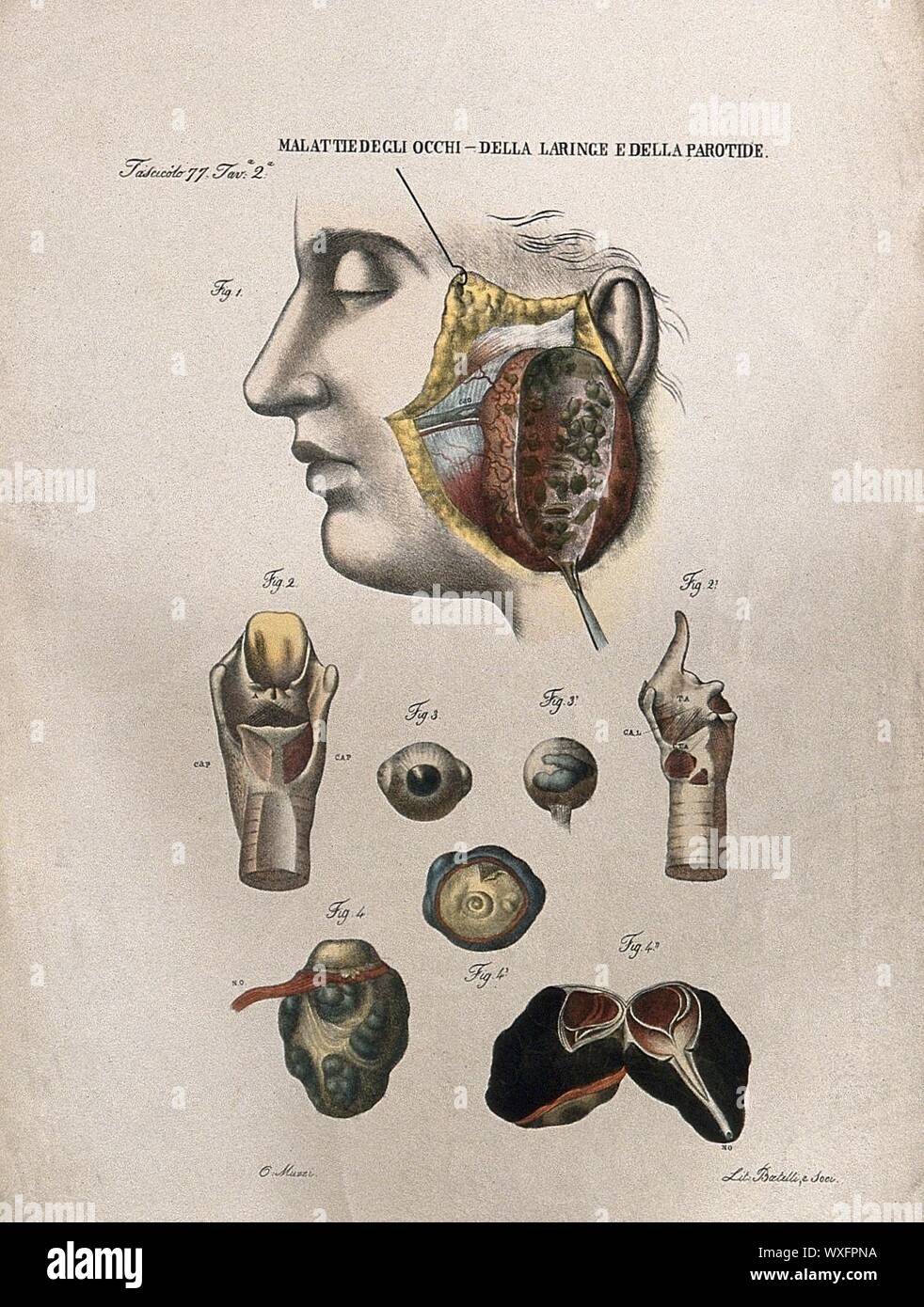 Plusieurs exemples des maladies des yeux, de la (larynx) et de la