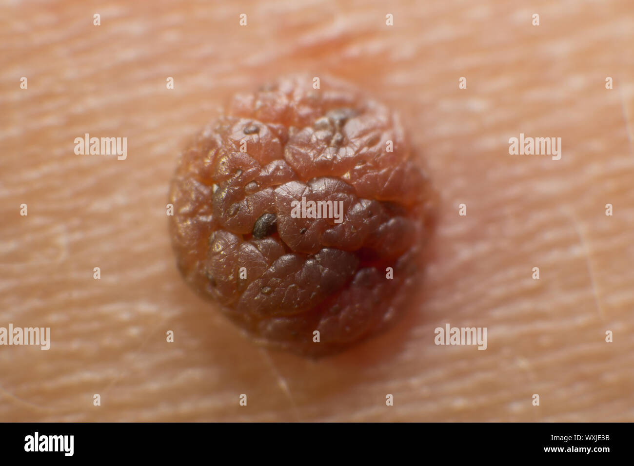 Mole sur la peau du corps. Tâche de naissance. Acrochordon Banque D'Images