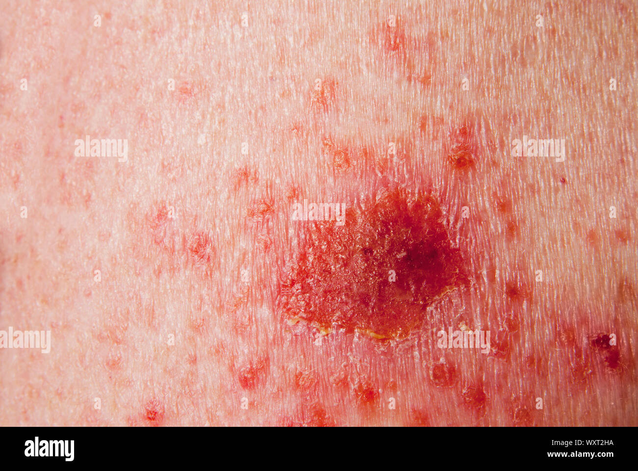 Cancer De La Peau Traitement Cancer of the skin Banque de photographies et d’images à haute