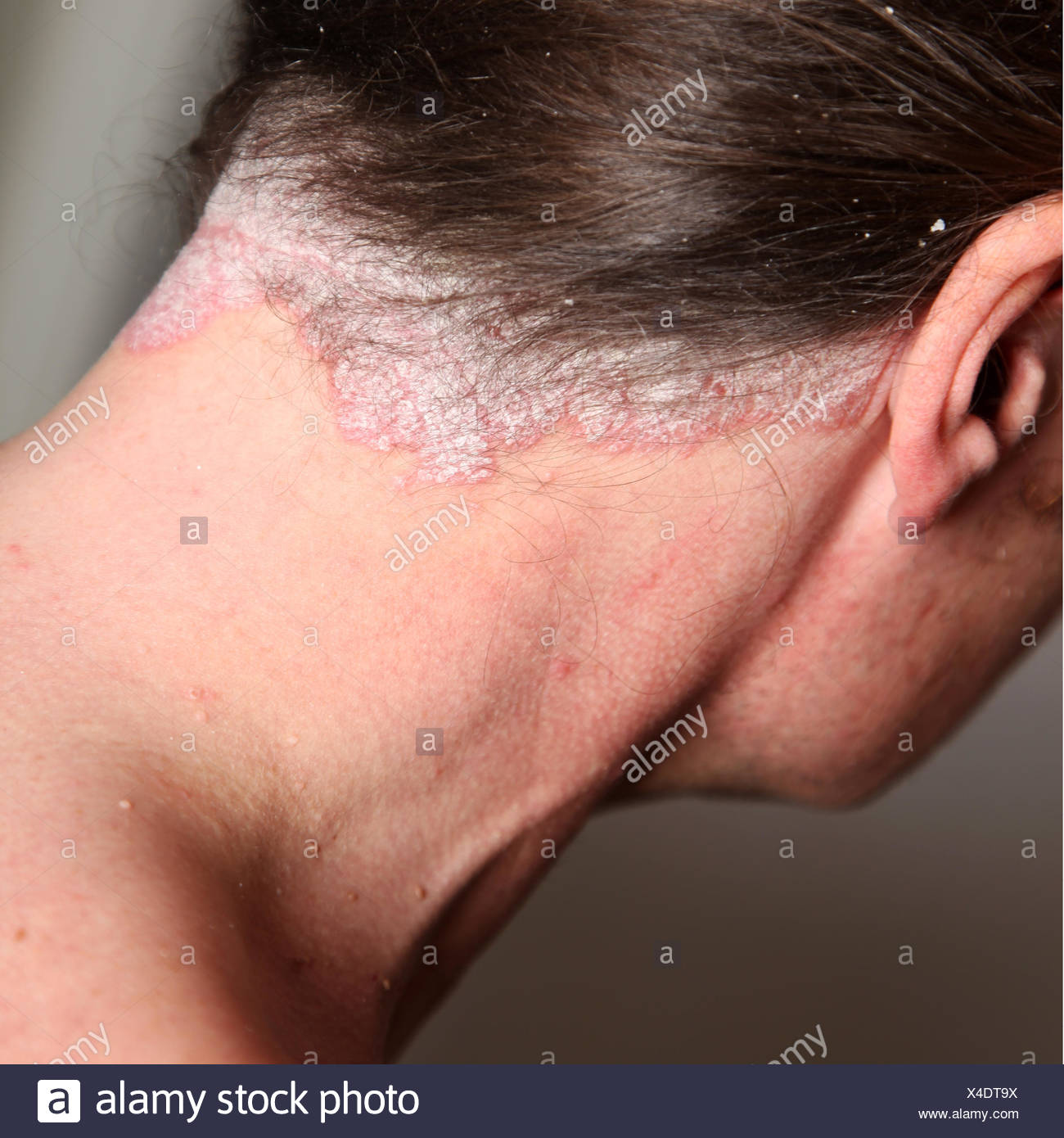 Psoriasis Nails Banque d