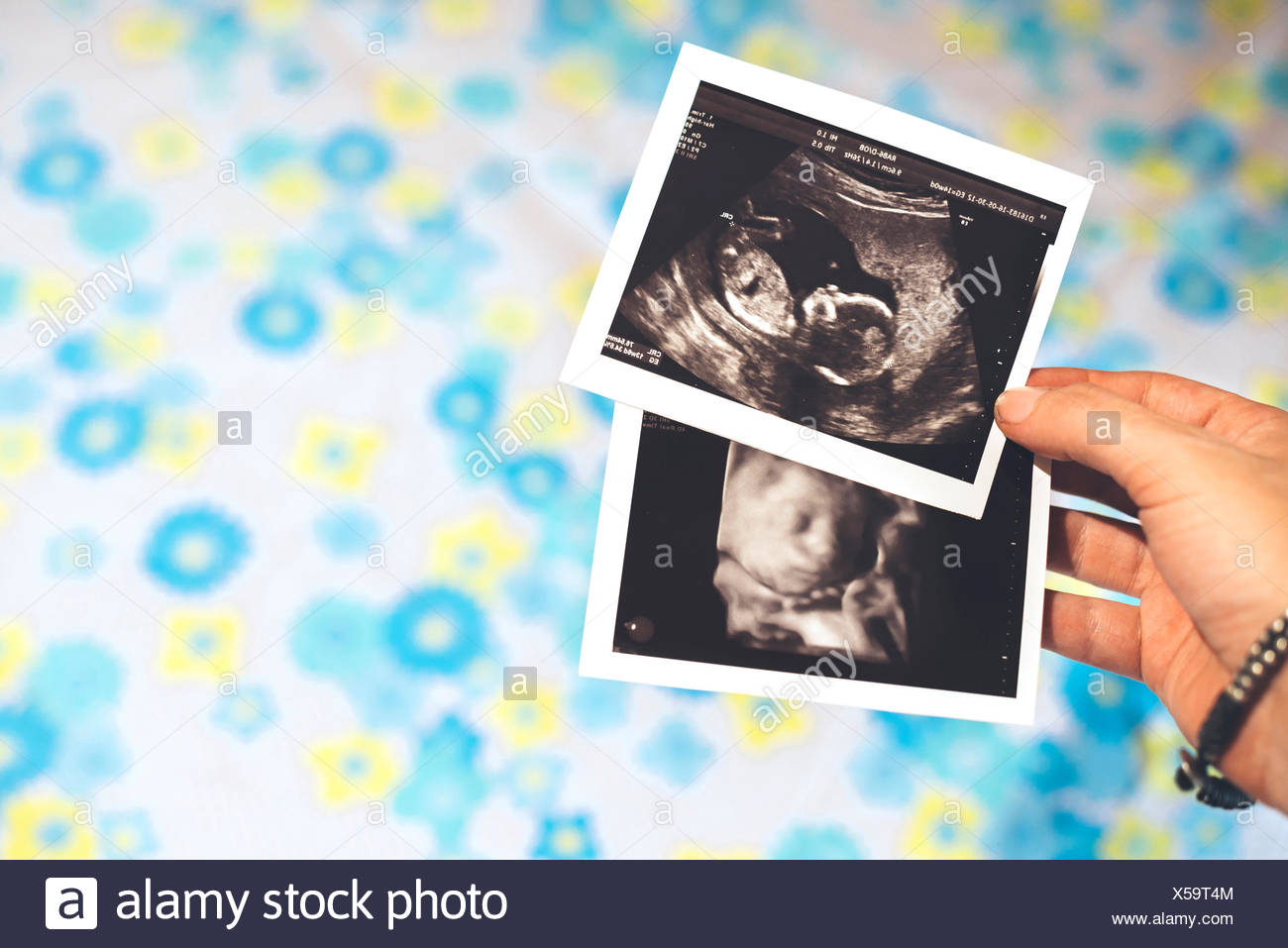 Echographie 3d Banque D Image Et Photos Alamy