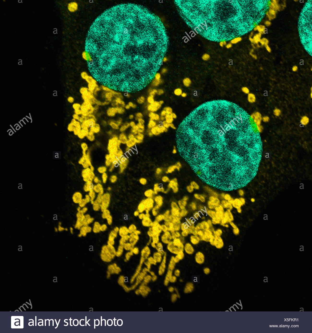 Image microscopique de mutation des cellules épithéliales humaines Banque D'Images