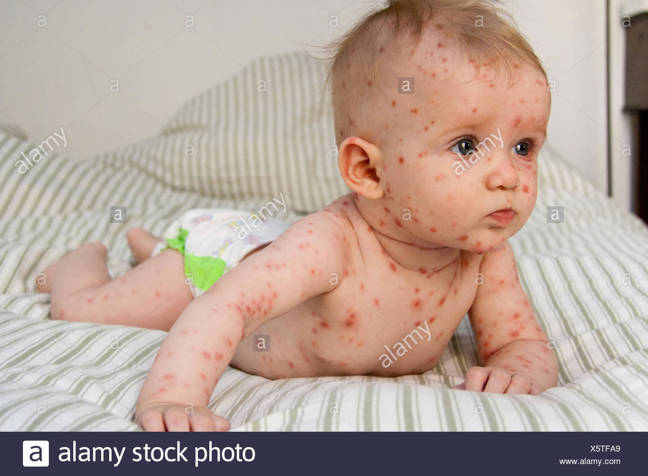 La Varicelle Sur Un Bebe De 4 Mois Photo Stock Alamy