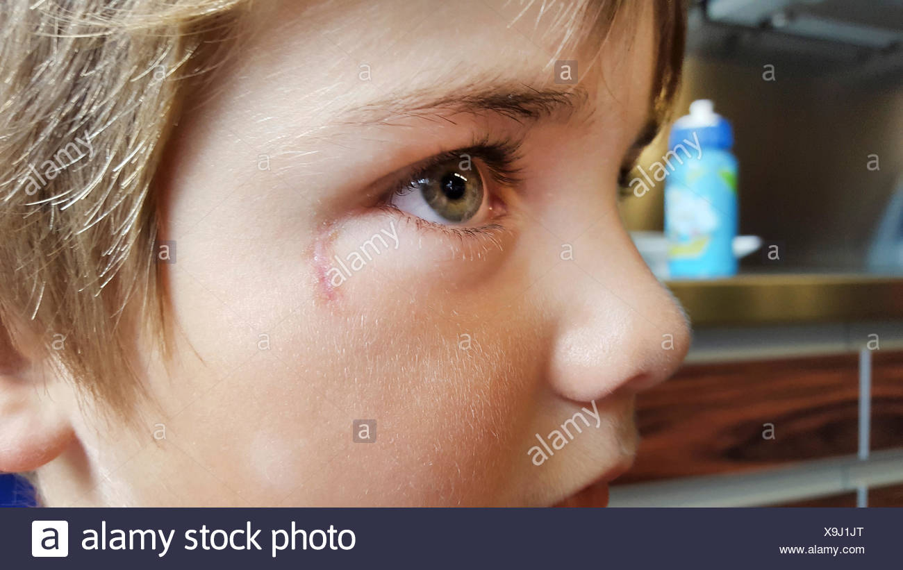Une Cicatrice Banque d'image et photos Alamy — free download