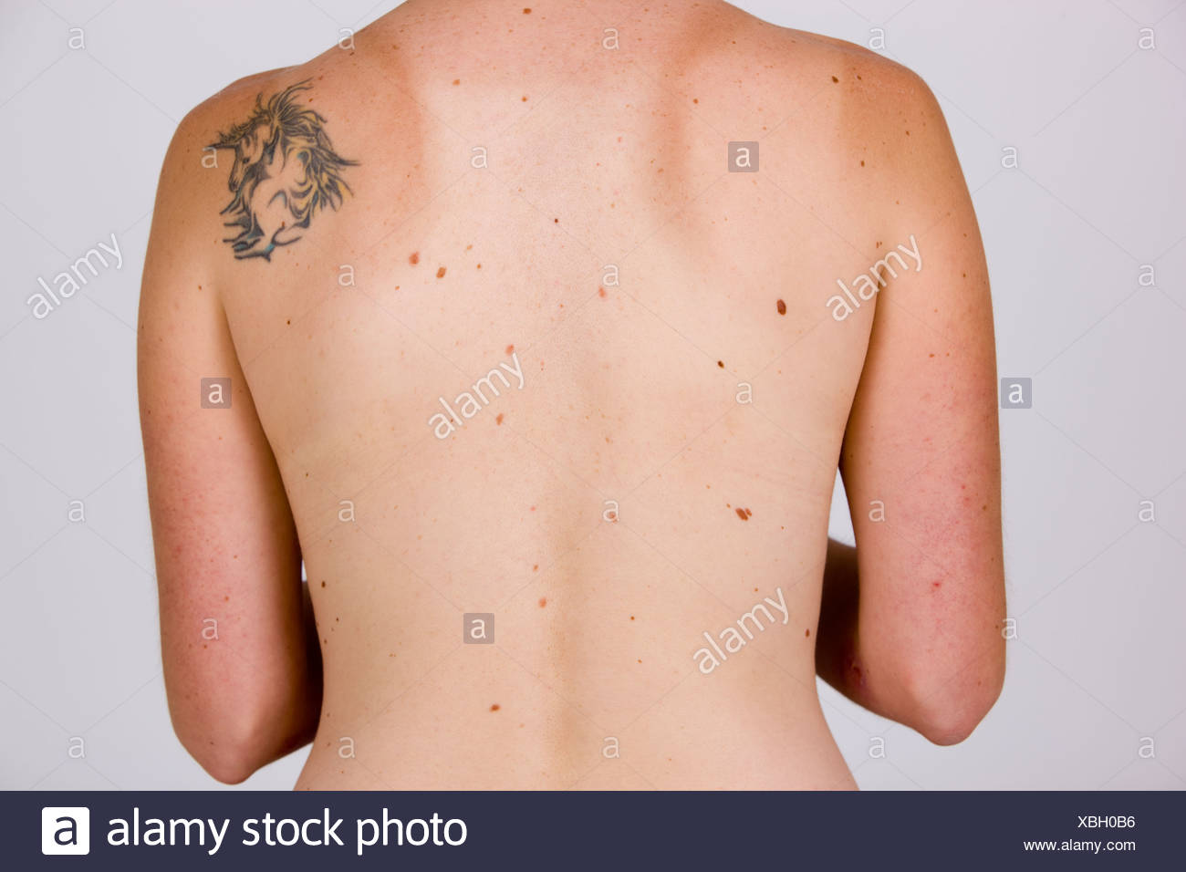 Beaute Sur Le Dos Le Risque De Cancer De La Peau Photo Stock Alamy