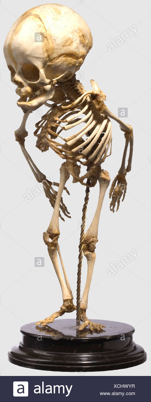 Scoliose Severe Banque D Image Et Photos Alamy