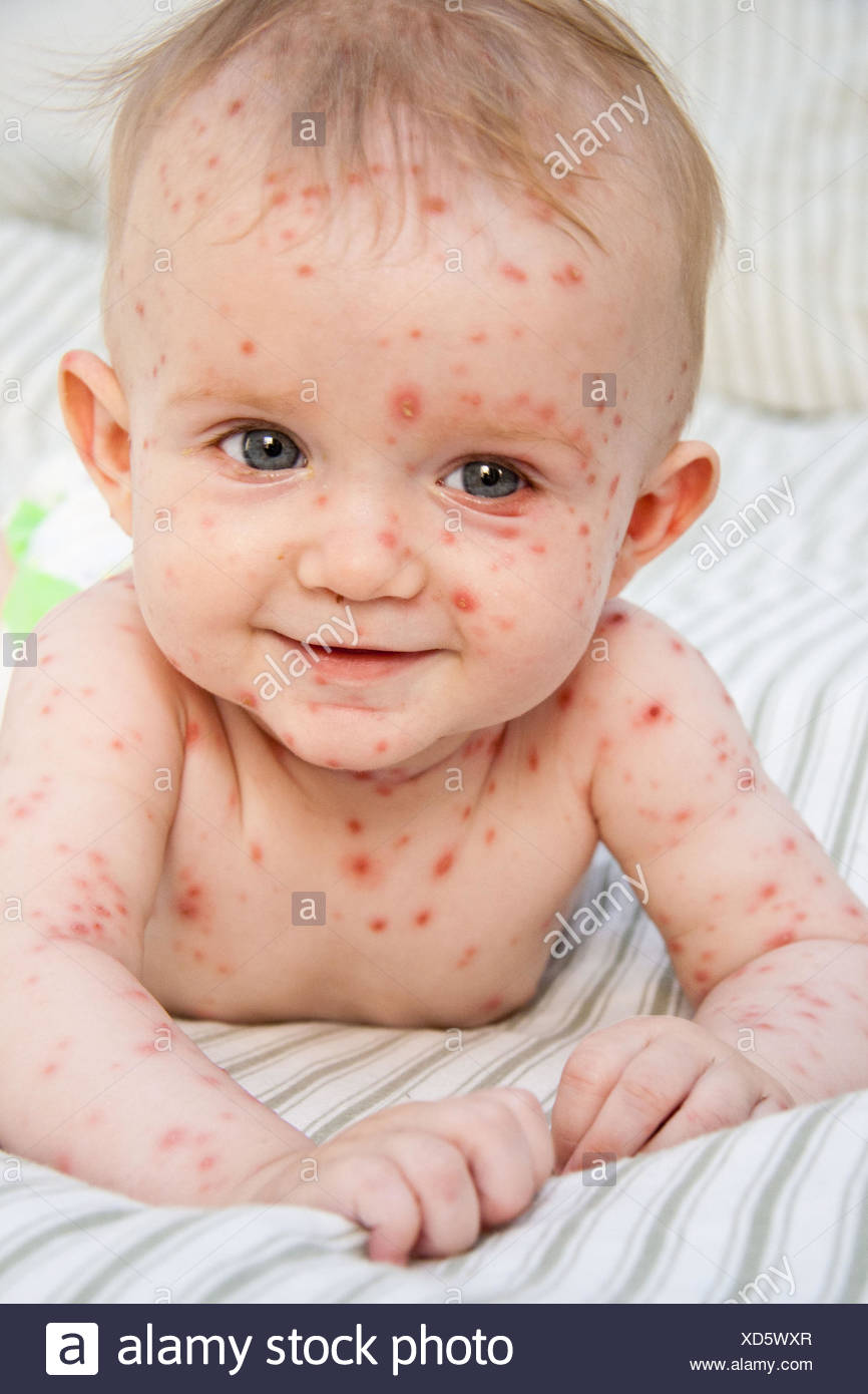 Maladie Infantile Banque D Image Et Photos Alamy